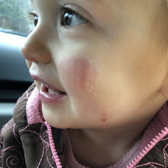 Dog bite on face of baby