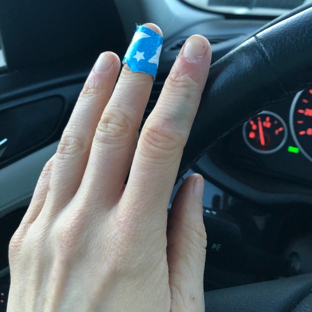 Broken and bruised pointer finger