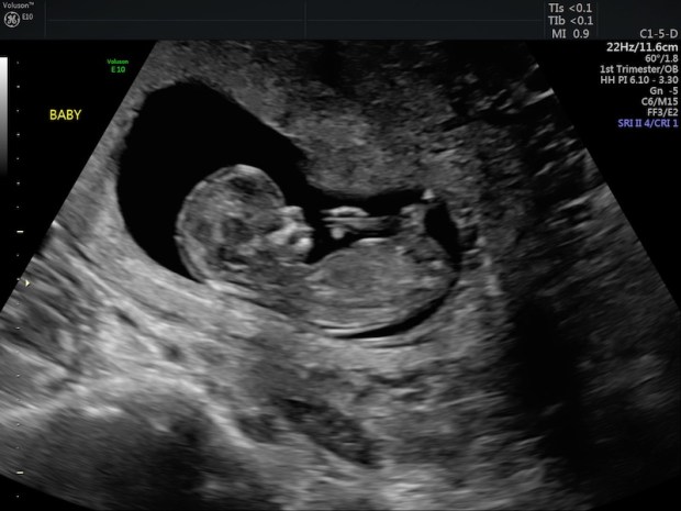 12 week ultrasound