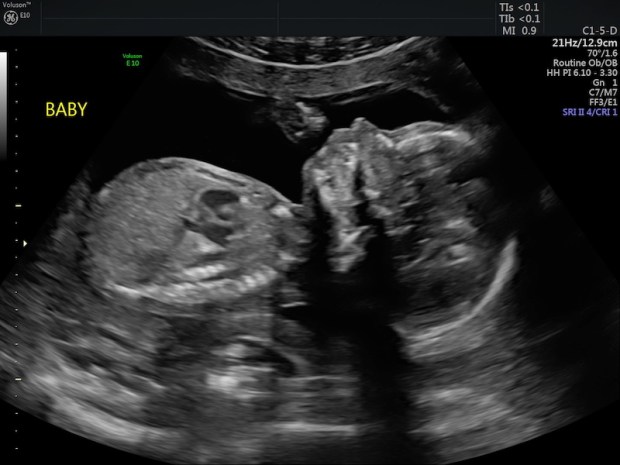 Baby boy 20 week anatomy ultrasound