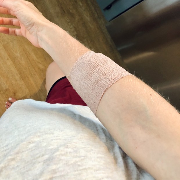 Forearm wrapped in a dressing after IV iron infusion during pregnancy