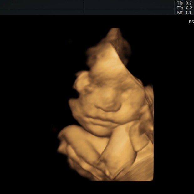 4D Ultrasound of baby boy in second trimester
