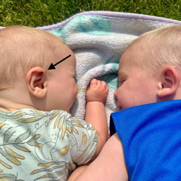 Baby with weird shaped ear