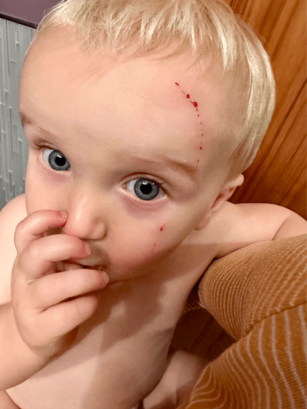 Baby with scratch on face from cat