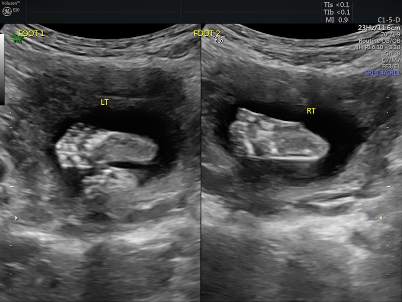 Baby feet at 20 week ultrasound